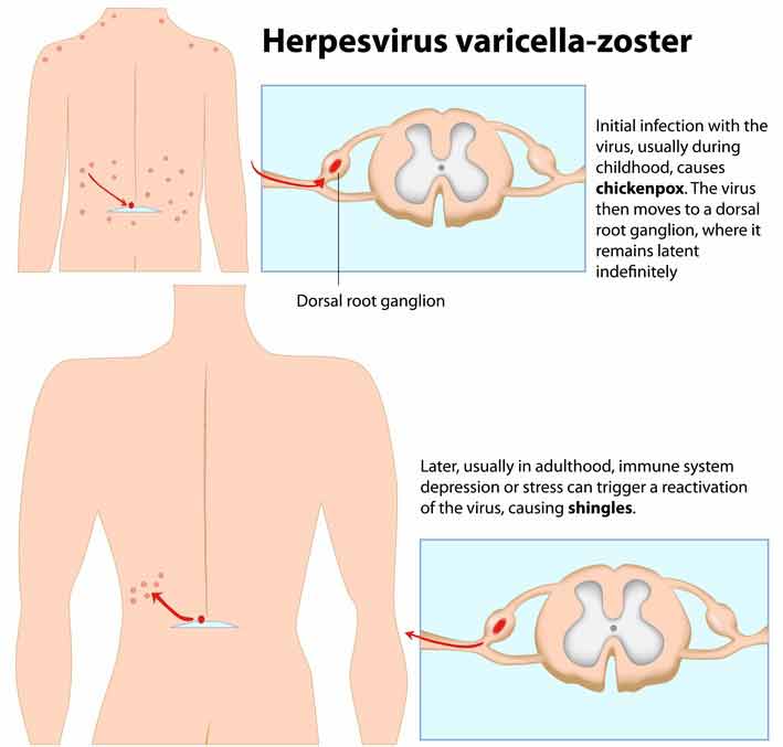 What are the Symptoms for Herpes Zoster? 