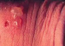 Picture of genital herpes