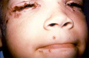 Photo of eye herpes