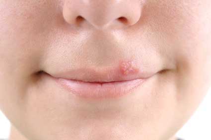 Picture of girl has herpes on her lips