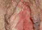 Picture of Woman with genital herpes