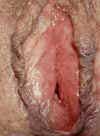 Picture  of a woman's  genitals with herpes