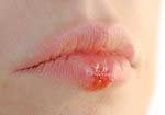 Photo of girl with herpes on her lip