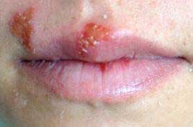 Girl has cold sores on her lips