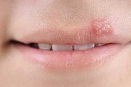 Picture of girl with herpes on her lip